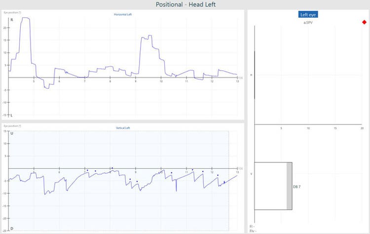 Graphs with eye position in degrees as a function of time in seconds. Nine recorded beats of vertical, down-beating nystagmus, yielding a down-beating nystagmus with an average slow phase velocity of 7. This is above the normal range of 0 to 6.