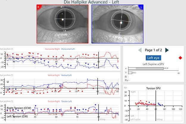 Results for eye position, average slow phase velocity, and torsion velocity are displayed in separate graphs. BPPV is detected, indicated by a red diamond.
