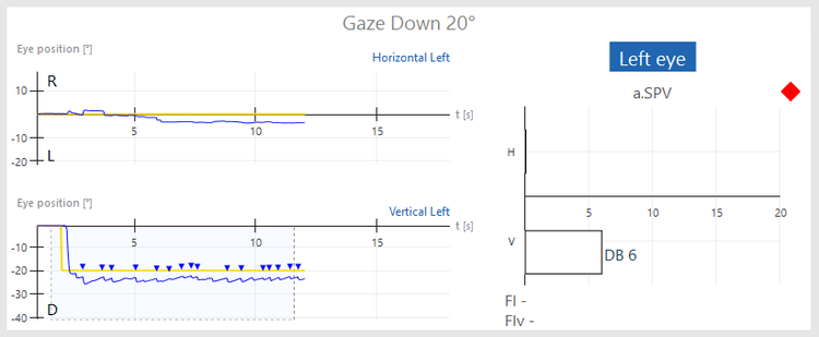 Gaze results overview for gaze down 20 degrees. For vertical left, the blue curve for eye position is jagged, indicating nystagmus. The average slow phase velocity of the nystagmus is 6. The nystagmus peaks are marked with a blue triangle, and the subtest is flagged with a red diamond.