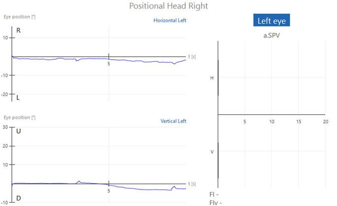 Graphs with eye position in degrees as a function of time in seconds. No horizontal or vertical nystagmus, visible by almost flat traces close to zero degrees. Another graph showing the average slow phase velocity also shows no horizontal or vertical nystagmus.