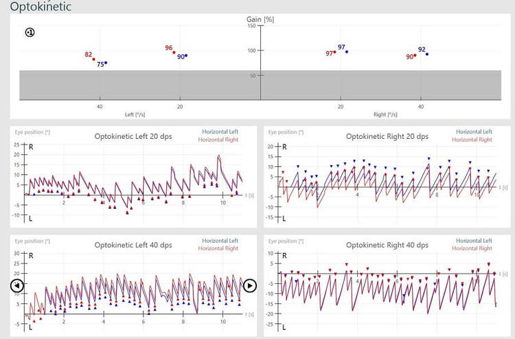 Results overview for right and left optokinetic nystagmus results, for 20 dps and 40 dps. For optokinetic left 20 dps, left horizontal gain is 90%, right horizontal gain is 96%, and eye position hovers between -10 to 20 degrees. For optokinetic left 40 dps, left horizontal gain is 75%, right horizontal gain is 82%, and eye position hovers between -5 to 20 degrees. For optokinetic right 20 dps, left horizontal gain is 97%, right horizontal gain is 97%, and eye position hovers between -10 to 15 degrees. For optokinetic right 40 dps, left horizontal gain is 92%, right horizontal gain is 90%, and eye position hovers between -20 to 5 degrees.