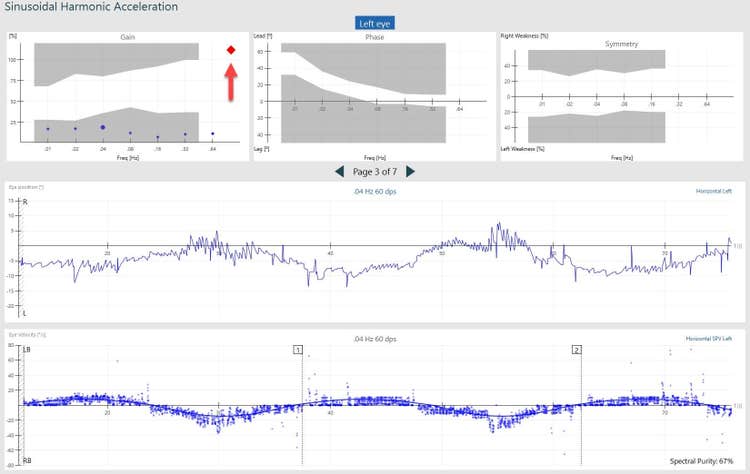 Asymmetric SHA response. Reduced VOR gain for all frequencies, visible with dots in a grey shaded area.