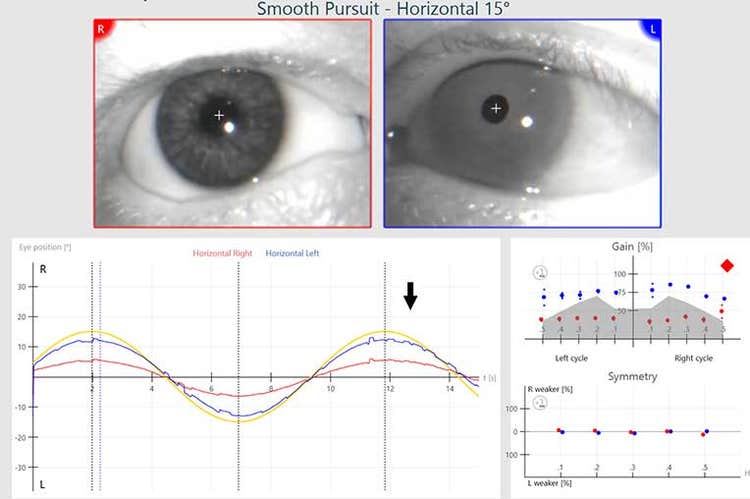 Smooth pursuit software screen with prosthetic eye on the right side