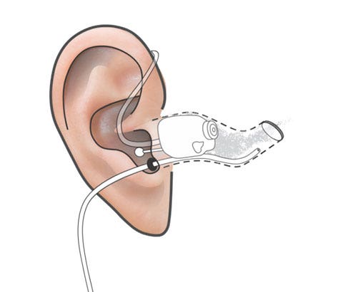 Ear with hearing aid and probe tube inserted. The black probe tube marker is at the intertragal notch.