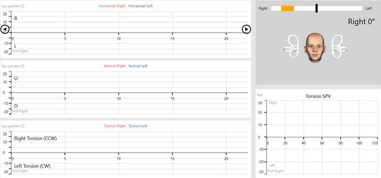 Eye position graphs in degrees as a function of time for horizontal, vertical, and torsion right and left. There is also a 3D head model displaying the current head position and in which position the head should be turned. Finally, there is a torsion SPV graph.