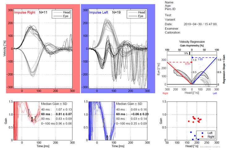 vHIT summary data displaying instant gain values, velocity regression and median gains