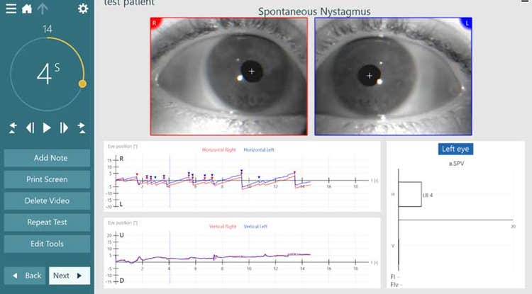 Test screen during data collection, with a video image of the patient’s eyes and the nystagmus tracings for horizontal and vertical eye movements.