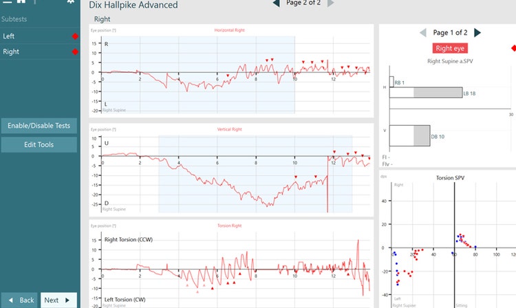 All eye position graphs display abnormal amounts of beating nystagmus.