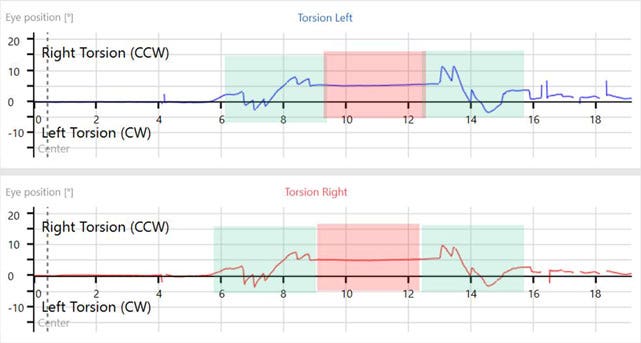 Ocular counter roll test software screen, showing torsional recordings.