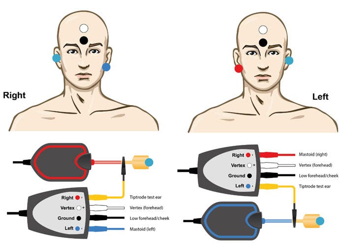 TipTrode in test ear, with electrode on opposite mastoid, forehead, and ground electrode on low forehead.