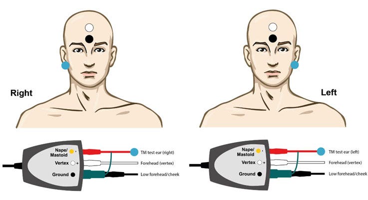 TM-trode cable in test ear, electrode on forehead, and ground electrode on low forehead.