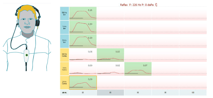 Man with probe in the right ear and headphone placed on the left ear. True ispilateral reflexes at 80 dB HL for 0.5, 1, and 2 kHz. True contralateral reflex at 85 dB HL for 0.5 kHz. True contralateral reflex at 90 dB HL for 1 kHz. True contralateral reflex at 80 dB HL for 2 kHz.