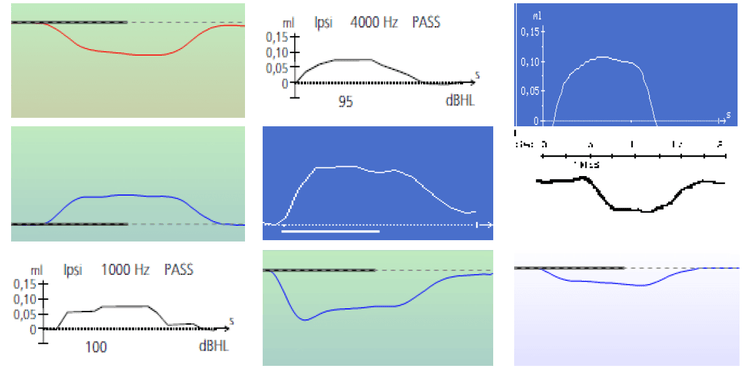 Nine different, true acoustic reflexes. All have a flat peak with a sufficient deflection value to pass as a reflex.